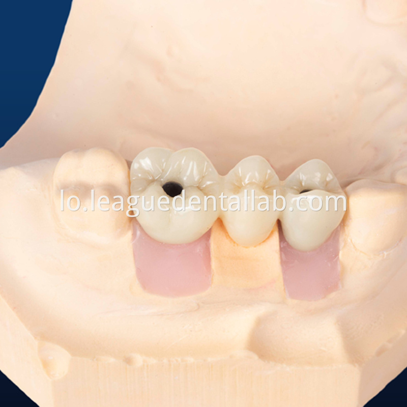 Dental Implant Crown, Dental Implant Zirconia crown,Dental Implant Emax crown,Dental Implant Bridge